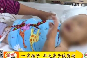 東平：一歲孩子 半邊身子被燙傷